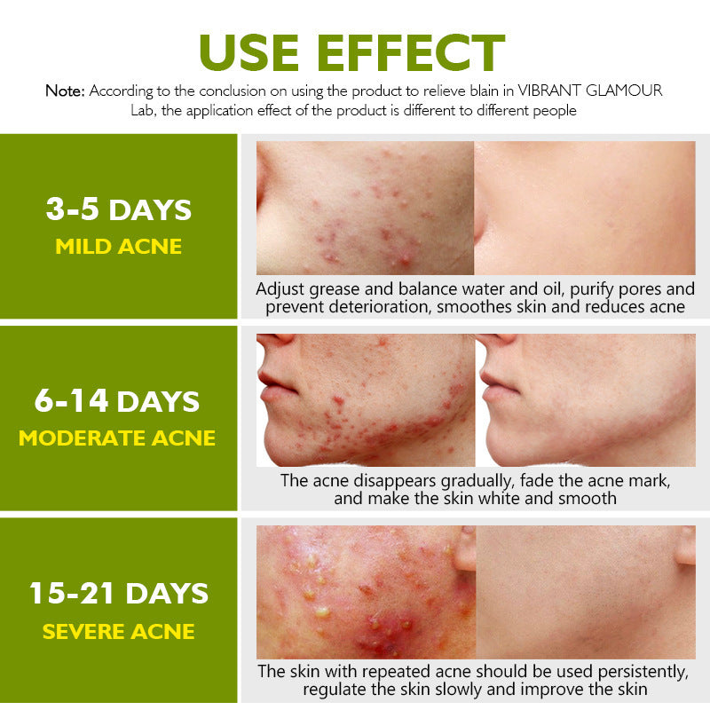 VIBRANT GLAMOUR Herbal Acne Cream 30g
